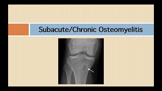 Subacute and chronic osteomyelitis [upl. by Chaiken]