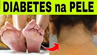 9 SINAIS de DIABETES na PELE [upl. by Niessuh]