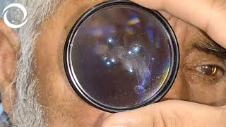 How actual floaters looks inside Eye [upl. by Imotas78]