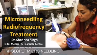 Microneedling RadiofrequencyRF Treatment  Secret RF  Nitai Cosmetics  Melbourne [upl. by Esyak395]