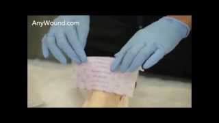 SelfAdaptive wound dressing Application on Full Thickness Heel Wound Model [upl. by Pontius]