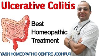 Ulcerative Colitis treatment ।IBS ।stomach pain।blood mucus in stool homeopathy Treatment [upl. by Anuhsal]