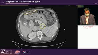 Diagnostic de la cirrhose en imagerie  R Sartoris [upl. by Anwahsar]