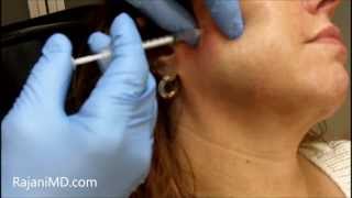 Watch Botox Facial Shaping and TMJRajani [upl. by Vookles]