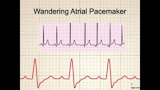 Atrial Rhythms Part 1 [upl. by Ahsilrac]