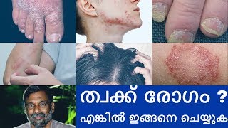 Psoriasis  Skin diseases treatment  Mohanan Vaidyar [upl. by Ahsienom]