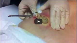 Biggest Pimple Pop Ever Caught On Camera Guiness World Record [upl. by Mariko]