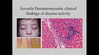 Juvenile Dermatomyositis 101 [upl. by Goldman496]