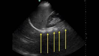 Pleural Effusion Ultrasound [upl. by Lajet]