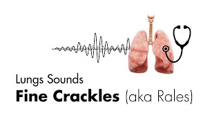 Fine Crackles Rales  Lung Sounds  MEDZCOOL [upl. by Ahsiyn348]