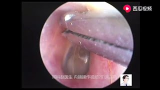 Treatment of foreign bodies cerumen and fungi on tympanic membrane surface for 11 minutes [upl. by Frangos]