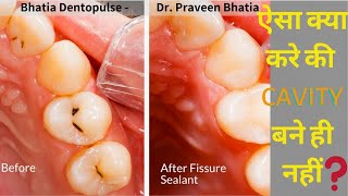 Pit And Fissure sealants of Teeth  How To Get Rid of Cavity Dr Praveen Bhatia [upl. by Acceber]