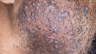 Removing Embedded Ingrown Hairs [upl. by Eniaral]