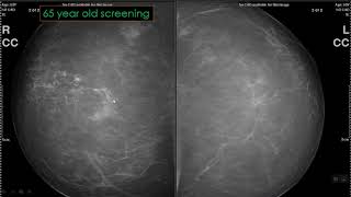 Approach to Calcifications on Mammography [upl. by Cristiano]