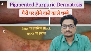 पैरों पर होने वाले काले धब्बे  Legs पर उपस्थित Black spots का इलाज़  Pigmented Purpuric Dermatosis [upl. by Htebilil102]