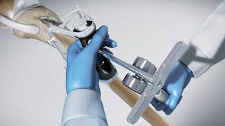 INTRAFIX™ ADVANCE Tibial Fastener System [upl. by Attolrahc]