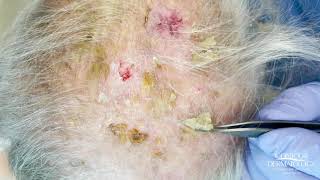 Debulking Lesions on the Scalp Erosive Pustulosis of the Scalp  CONTOUR DERMATOLOGY [upl. by Elamef]