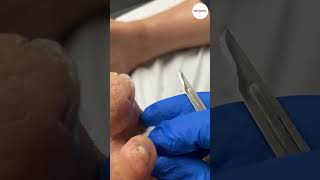 Tip of Toe Callus Removal [upl. by Seroled]