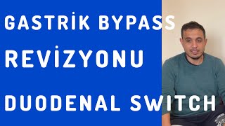 Gastrik Bypass Sonrası Dumping Sendromu Nedeniyle Duodenal Switch’e Revizyon [upl. by Wheelwright238]