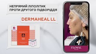 Непрямий ліполітик проти другого підборіддя з Dermaheal LL [upl. by Primrose]