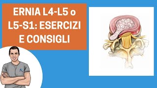 Ernia L4L5 o L5S1 ecco come curarsi consigli ed esercizi [upl. by Eidoow440]