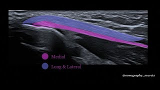 Triceps rupture ultrasound [upl. by Lectra]