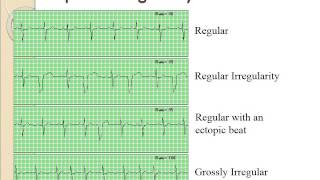 Basic Dysrhythmias [upl. by Mmada896]