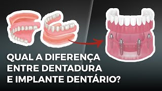 Qual a diferença entre dentadura e implante dentário [upl. by Sunshine]