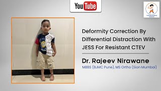 Deformity correction by differential distraction with JESS for resistant CTEV Done by Dr Nirawane [upl. by Lynad911]