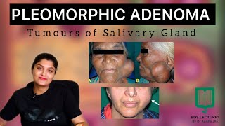 Pleomorphic Adenoma  Lecture 38  Salivary Gland Tumours  BDS  MDS  NEET MDS  Dental  Medical [upl. by Nnayllek]