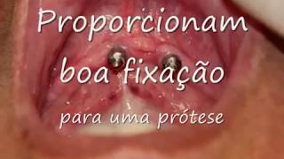 Como funciona uma overdenture com implante dentário  Prótese móvel com implantes dentários [upl. by Aligna888]