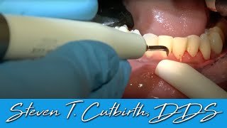 Scaling amp Root Planing  Dental Minute with Steven T Cutbirth DDS [upl. by Loredo]