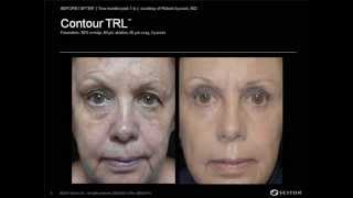 Sciton Laser Resurfacing Results  Franklyn Elliott MD FACS [upl. by Eilesor]