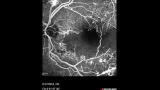 Proliferative Diabetic Retinopathy [upl. by Yrrat]