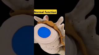 Vertebral Disc Herniation Animation [upl. by Verney]