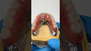 Locator Cast Metal TryIn lsk121shorts dentist dentistteeth [upl. by Inail]