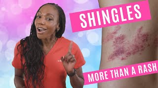 Shingles More Than A Rash [upl. by Hardner]