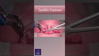 Tonsillitis Treatment With Heat Device tonsillitis [upl. by Nylle]