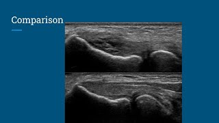 Successful treatment of elbow lateral epicondylitis  common extensor tendon partial tear [upl. by Perron566]