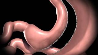 Realize Sleeve Gastrectomy Procedure Animation [upl. by Ancalin348]