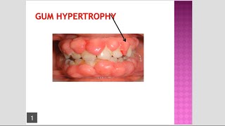 Gum Hypertrophy Gum Hyperplasia due to Phenytoin Amlodipine and Cyclosporine [upl. by Ydaf773]