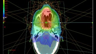 RTU MS Medical Dosimetry [upl. by Killarney]