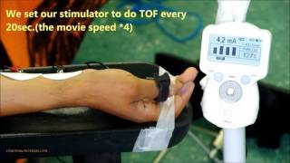 3Neuromuscular monitoring TOF for induction [upl. by Cindra]