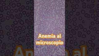 Así se ve la anemia al microscopio hematología anemia laboratorioclinico [upl. by Ricker139]