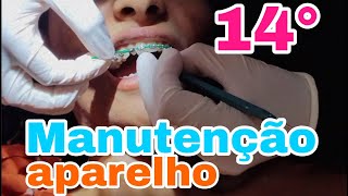 14° Manutenção de Aparelho Ortodôntico [upl. by Sachi]