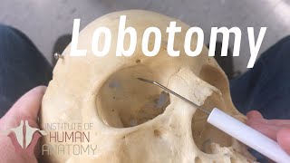 The Anatomy of a Lobotomy [upl. by Noirod]