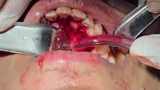 palatal approach for extraction of upper deep impacted canine with apical curved root [upl. by Yarazed]