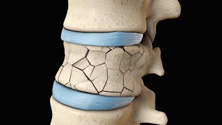 Back Surgery  Vertebroplasty and Kyphoplasty  Nucleus Health [upl. by Ikeda]