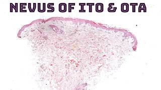 Nevus of Ito Ota Sun Hori amp Dermal Melanocytosis quotMongolian Spotquot under the microscope dermpath [upl. by Enovaj]