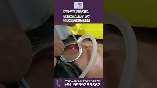 Nevus of OTA Treatment by Q Switch Laser  Best Laser Treatment on Face in Delhi  Dr PK Talwar [upl. by Eerol]